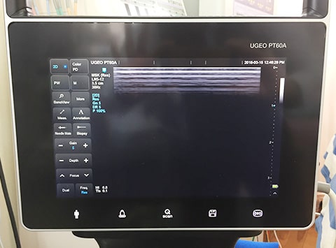 超音波画像観察装置を使用した検査